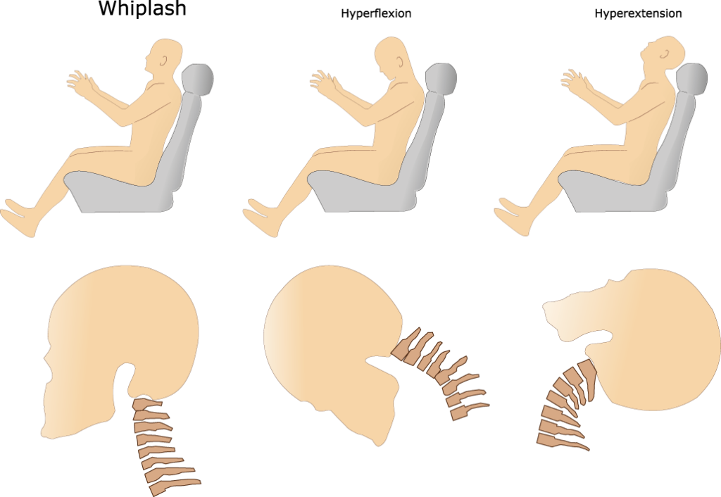 A look into what a whiplash injury looks like